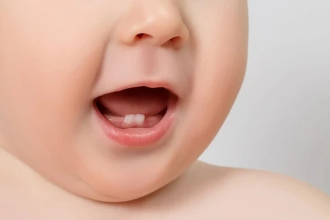 Dính thắng lưỡi ở trẻ em