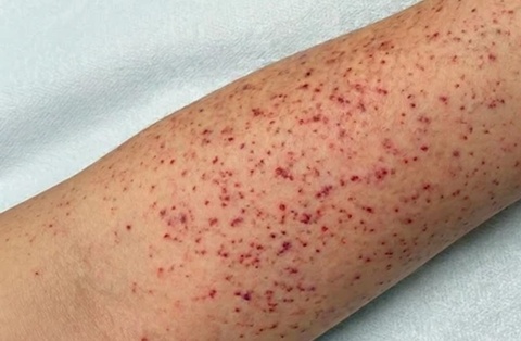 Dấu hiệu cảnh báo bệnh não mô cầu đang chuyển nặng