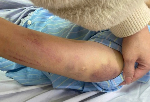 Nu sinh lop 7 o Nghe An nghi bi bo danh bam tim khap nguoi hinh anh