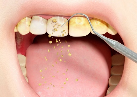 5 nguyen nhan gay hoi mieng hinh anh