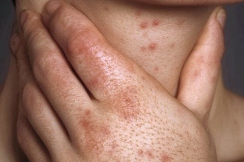 Mot benh lay qua tinh duc dang lan rong o nhieu nuoc chau A hinh anh