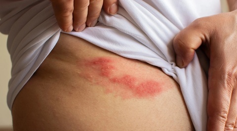 3 trieu chung thuong gap cua benh zona hinh anh