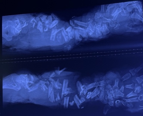 Nguoi dan ong nhap vien voi canh tay dap nat, xuong gay tram manh hinh anh