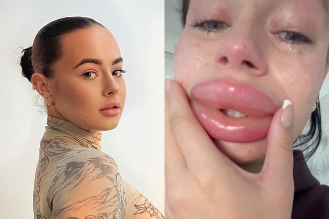 Filler môi bị hỏng là gì? Filler môi bị hỏng là gì?