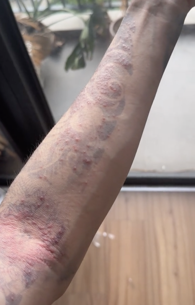 Hình minh họa các trường hợp da nhạy cảm và viêm da cơ địa không nên xăm hình theo khuyến cáo bác sĩ da liễu
