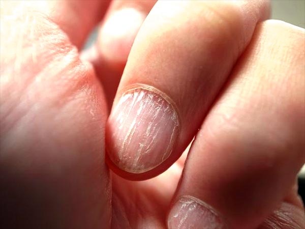 Dấu hiệu bệnh nguy hiểm qua nh&igrave;n m&oacute;ng tay | Znews.vn