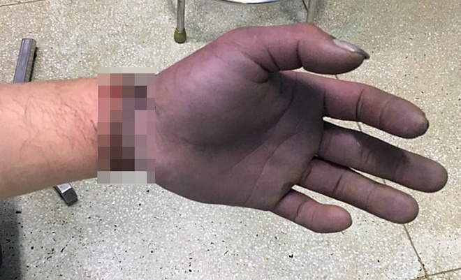 Bàn tay tím đen do bị dây kẽm siết chặt - Sức khỏe