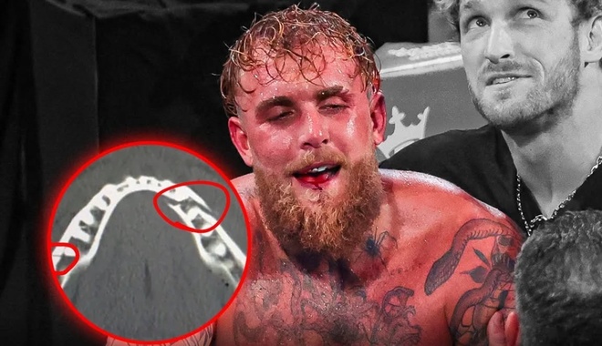 Jake Paul gãy xương hàm, bị cấm thượng đài | Znews.vn