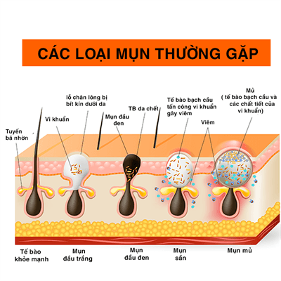 mun trung ca anh 1