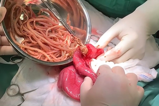 Gắp 60 con giun đũa trong ruột của bé 4 tuổi | Znews.vn
