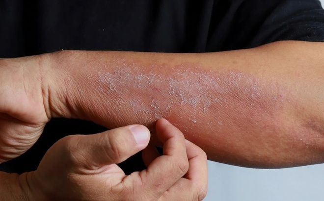 Dấu hiệu suy thận biểu hiện ở tay chân | Znews.vn