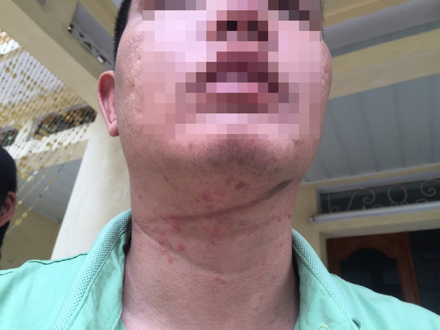 tram cam la nguyen nhan tu tu anh 1