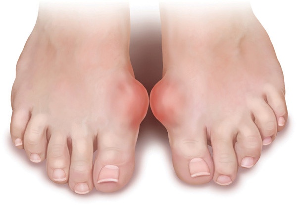 benh gout anh 1