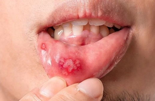 lay truyen HIV anh 1