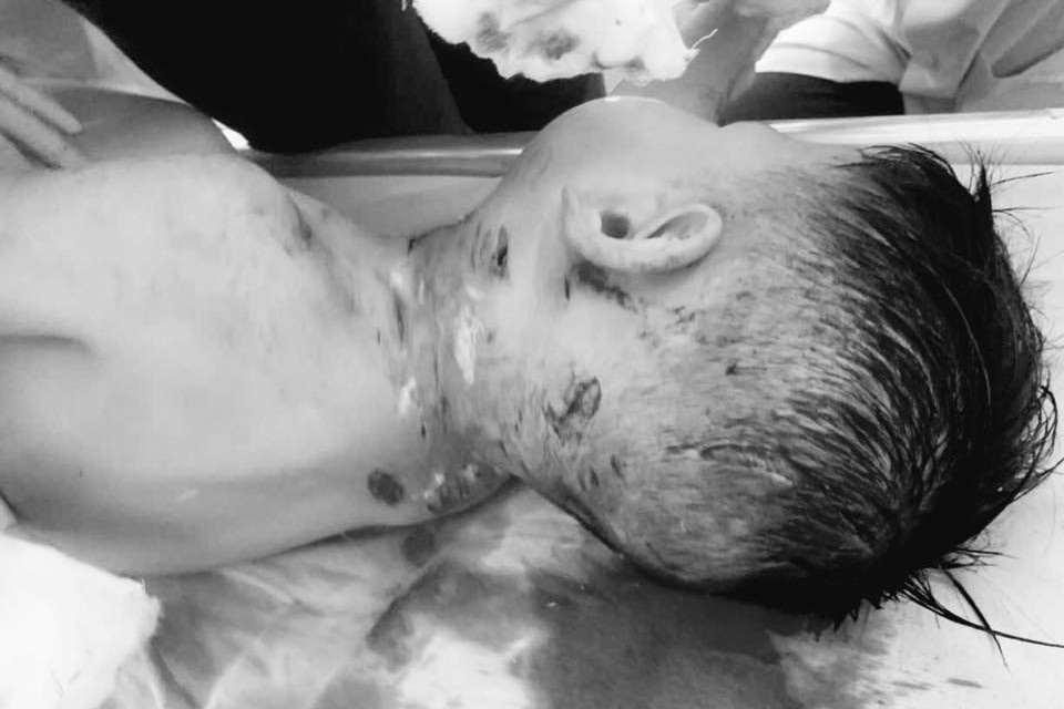 Bé trai 3 tuổi ở Lào Cai bị chó cắn lộ xương sọ